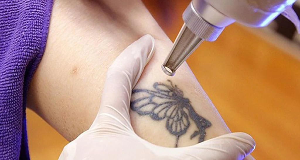 máy xóa hình xăm cao cấp, chất lượng giá tốt tại Sendora