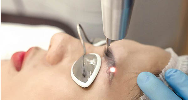 Mua máy xóa xăm laser liên hệ 0975 726 172