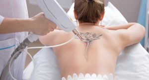 Mua máy xóa xăm laser cao cấp chất lượng tại Sendora