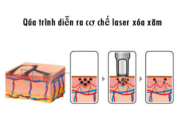 Máy laser trục khuỷu xoa xăm công nghệ Picoway