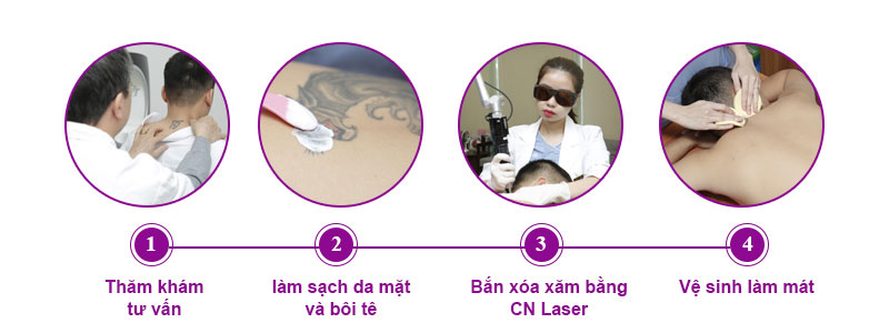 Quy trình xóa xăm bằng công nghệ laser