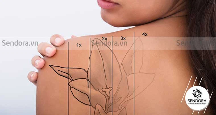 Tự xóa hình xăm tại nhà 2021: Sự thật nguy hiểm đằng sau các mẹo vặt trên Internet