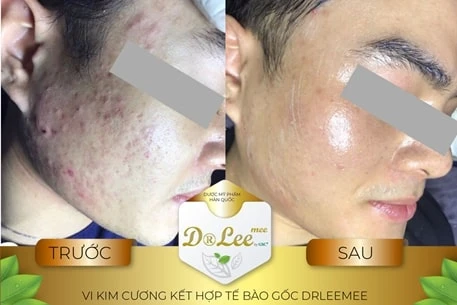 Vi Kim Sinh Học Là Gì? Tìm hiểu về Serum Kim cương Dr.Leemee Diamond Dust Magic Serum 4 Vi Kim Sinh Học Là Gì? Tìm hiểu về Serum Kim cương Dr.Leemee Diamond Dust Magic Serum