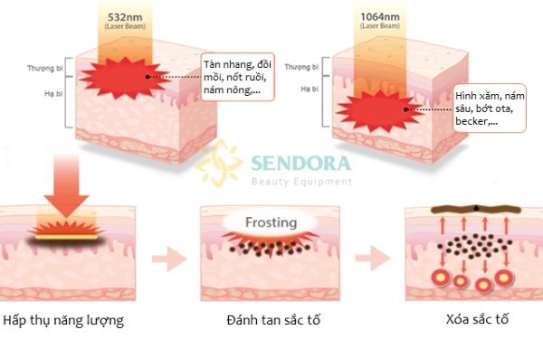 Các Bước Sóng 532nm Và 1064nm Có tác Dụng Xóa Xăm Chân Mày Và Điều Trị Những Tổn Thương Sắc Tố Da