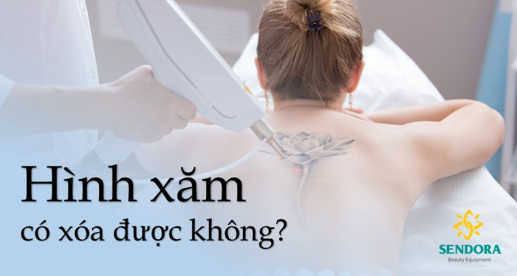 Hình Xăm Xóa Được Không? - Chia Sẻ Từ Chuyên Gia