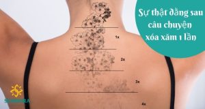Sự Thật Đằng Sau Câu Chuyện Xóa Xăm 1 Lần