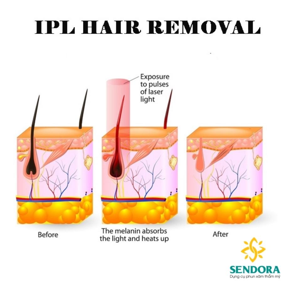 Công nghệ triệt lông IPL là gì?