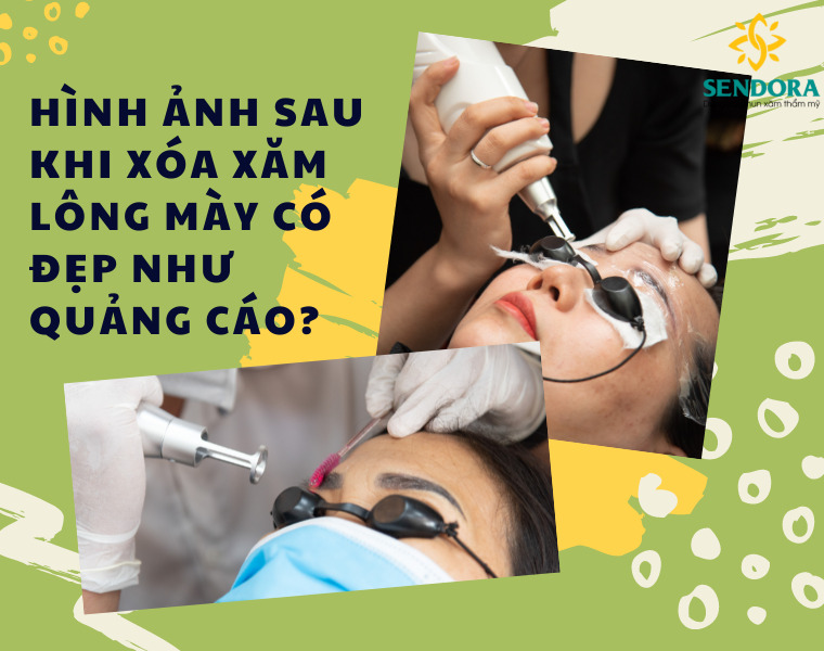 Hình ảnh sau khi xóa xăm lông mày có đẹp như quảng cáo?