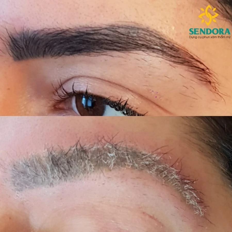 Tại sao xóa xăm lông mày bằng laser lại bị cháy lông, bạc lông?