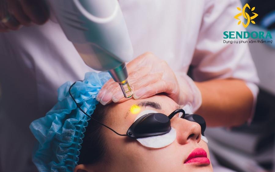 Xóa xăm lông mày bằng laser là phương pháp được nhiều chuyên gia khuyên dùng