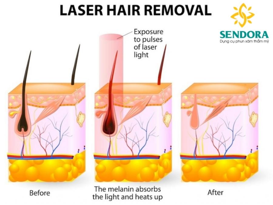 Cơ Chế Máy Triệt Lông Diode Laser Hoạt Động Như Thế Nào?