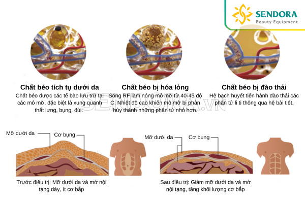 Công nghệ giảm béo RF