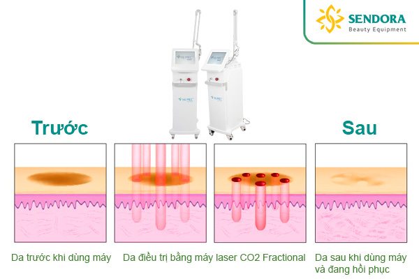 Máy CO2 Fractional là gì có công dụng ra sao?