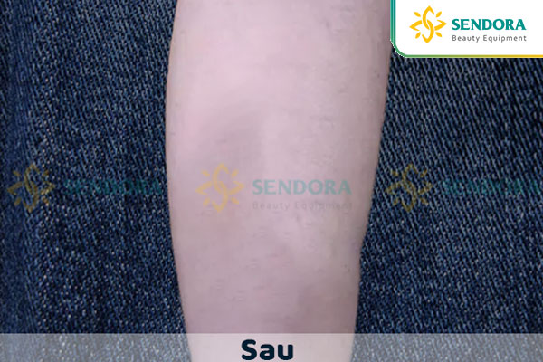 Sau khi sử dụng máy xóa xăm laser mini giá rẻ mua tại Sendora