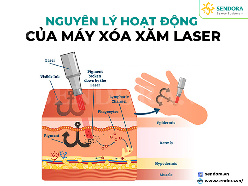 Mực xăm sau khi bị tia laser từ máy xóa xăm phá vỡ thành những phân tử siêu nhỏ dễ dàng đào thải ra ngoài cơ thể