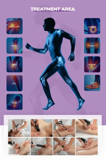 Các vùng điều trị của Máy trị liệu bằng sóng xung kích SW-14-1